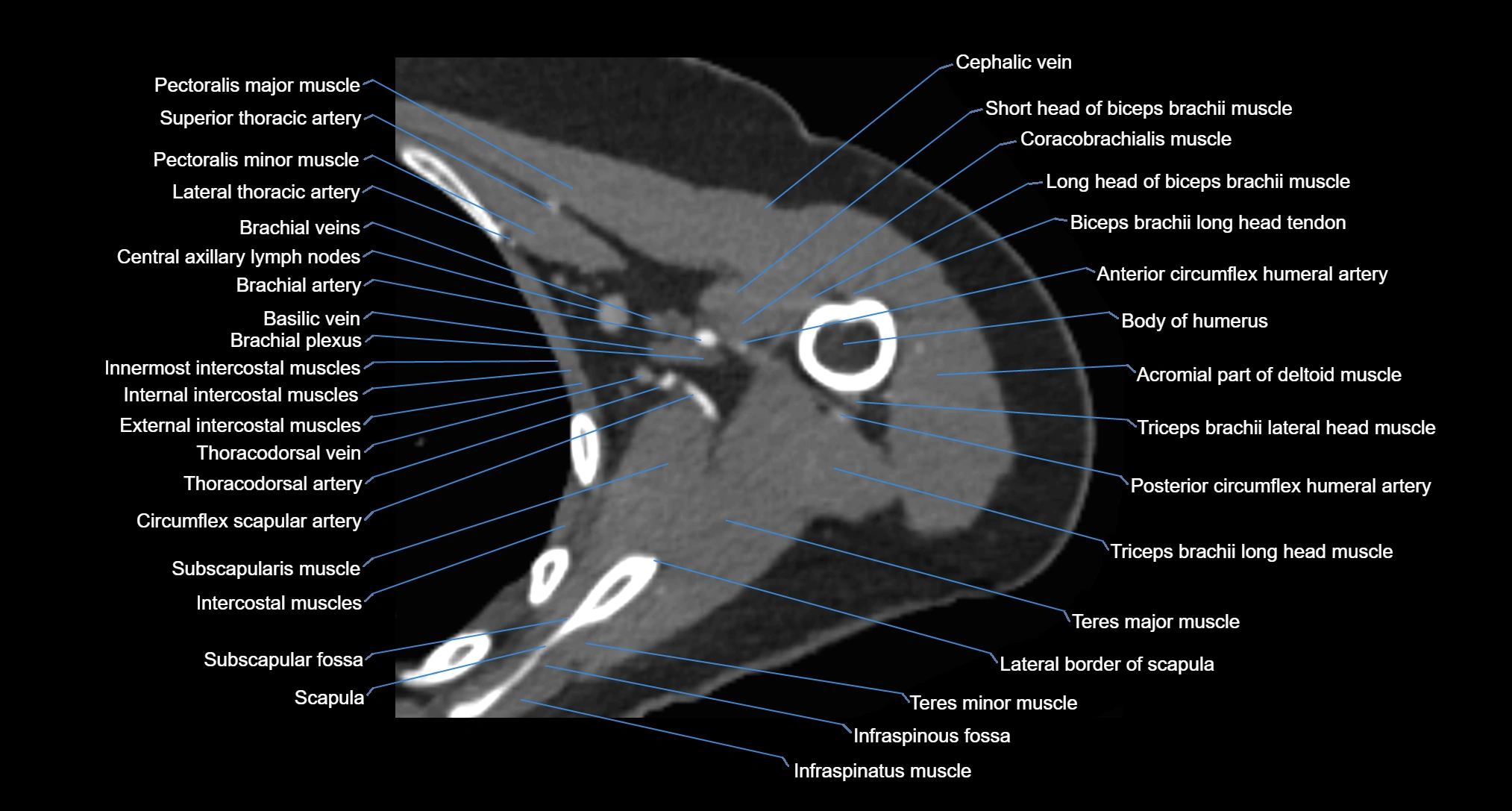 CT Shoulder axial cross sectional anatomy labelled radiology image -00052.webp